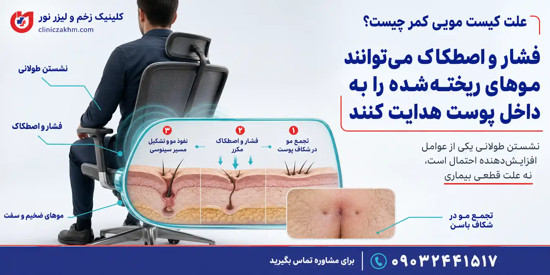 علت ایجاد کیست مویی در ناحیه کمر و دنبالچه