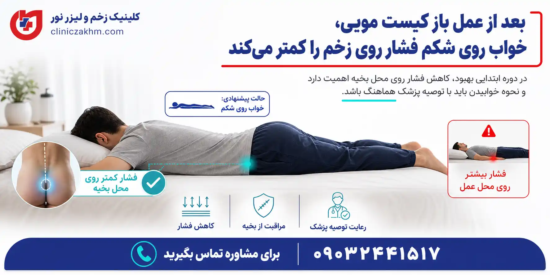 نحوه صحیح خوابیدن بعد از عمل باز کیست مویی و مراقبت از زخم جراحی