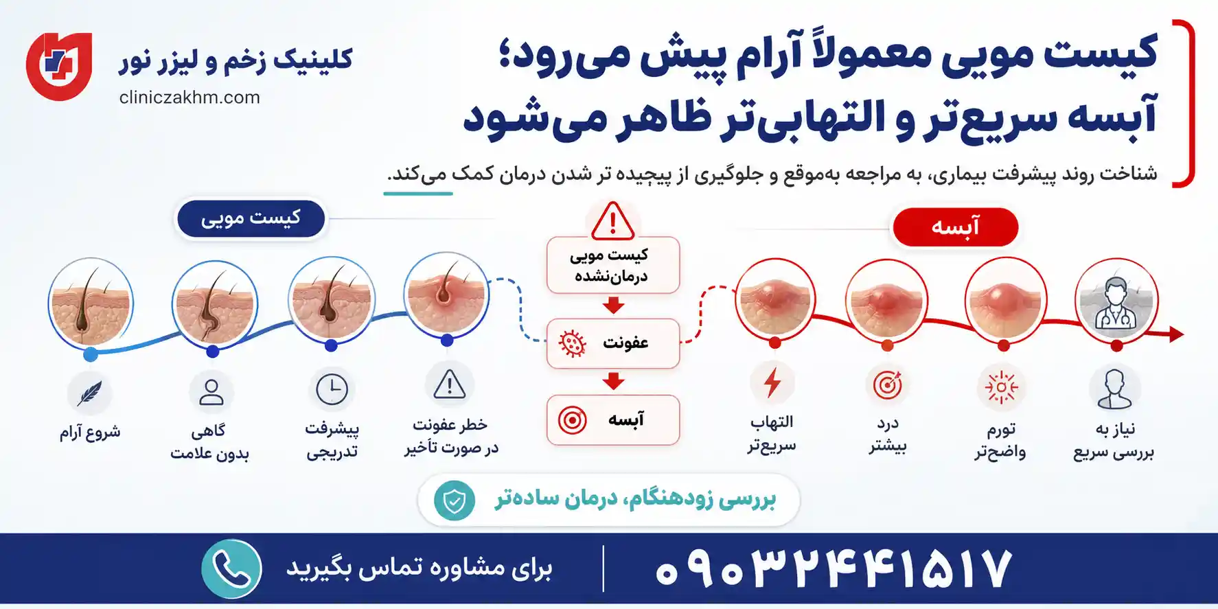 تفاوت روند پیشرفت آبسه و کیست مویی
