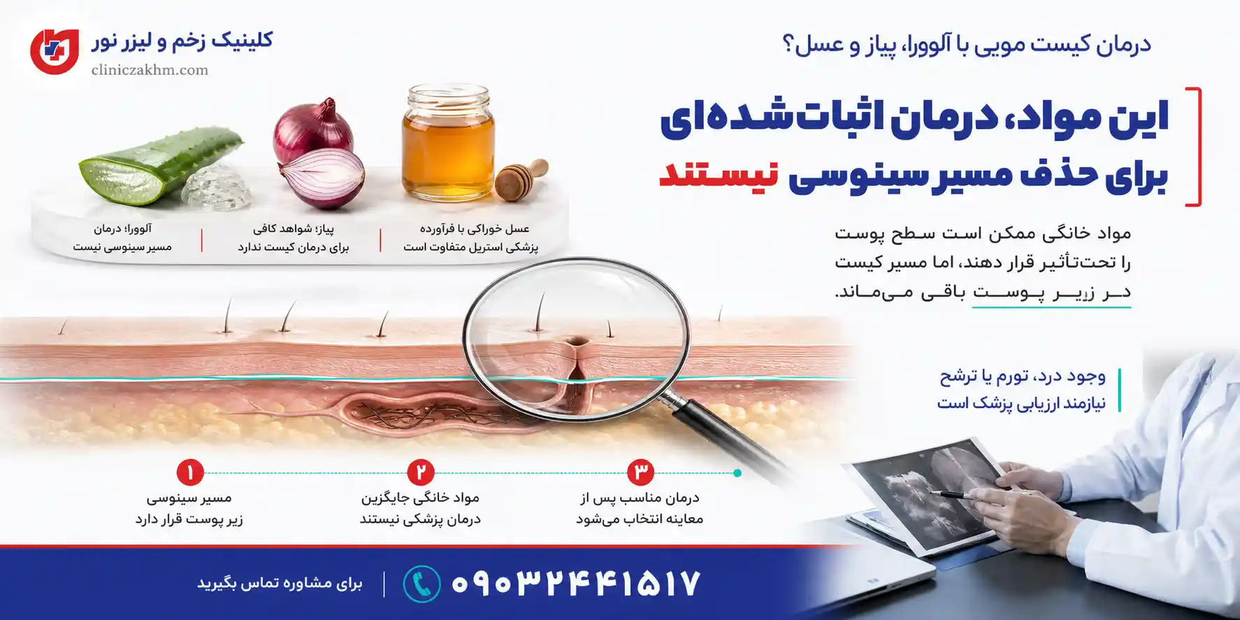 درمان خانگی کیست مویی با آلوئه‌ورا، پیاز و عسل