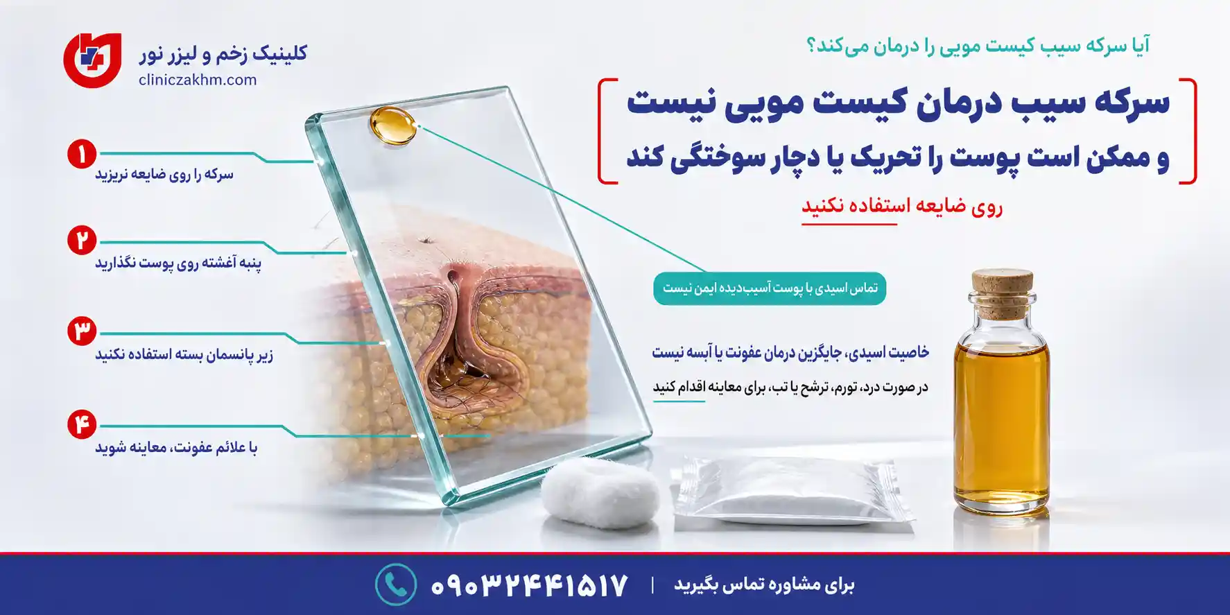 درمان خانگی کیست مویی با سرکه سیب