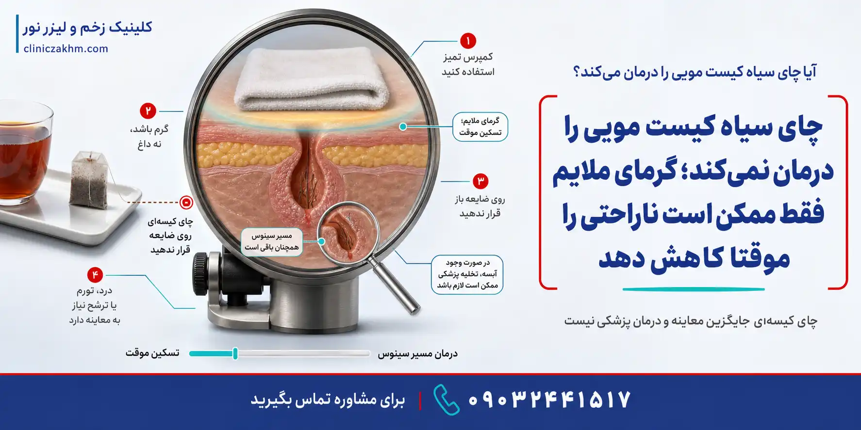 درمان خانگی کیست مویی با چای سیاه