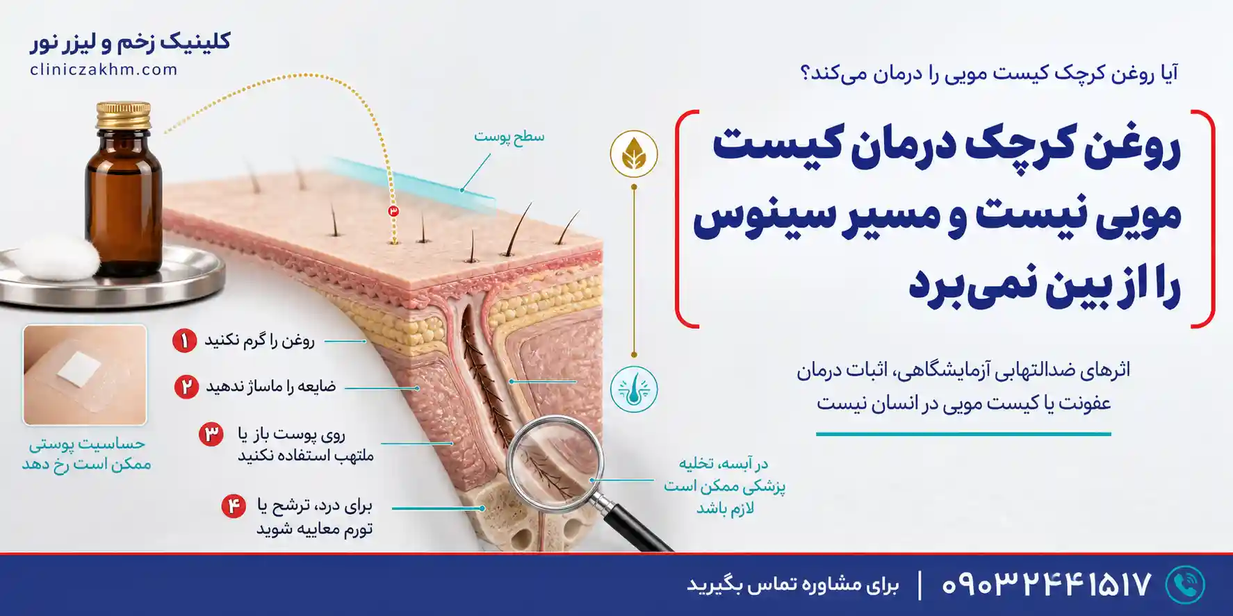 درمان خانگی کیست مویی با روغن کرچک