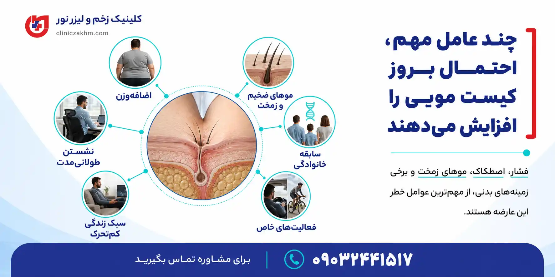 دلایل بروز کیست مویی و عوامل موثر در ایجاد سینوس پیلونیدال