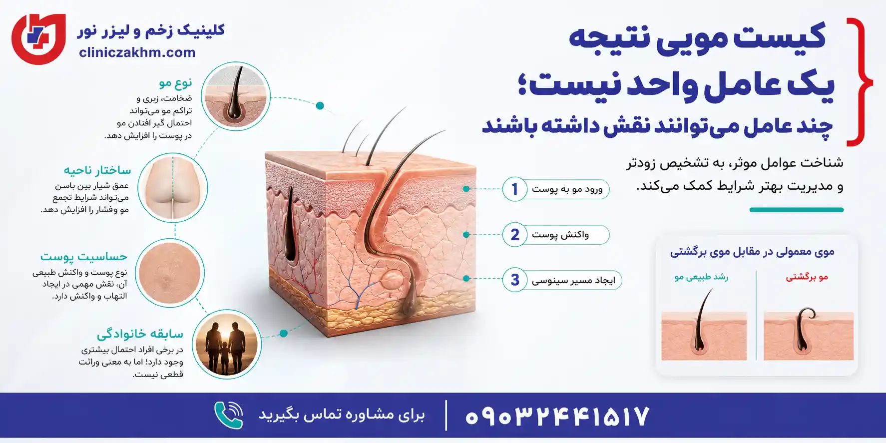 عوامل موثر در بروز کیست مویی و دلایل ایجاد سینوس پیلونیدال