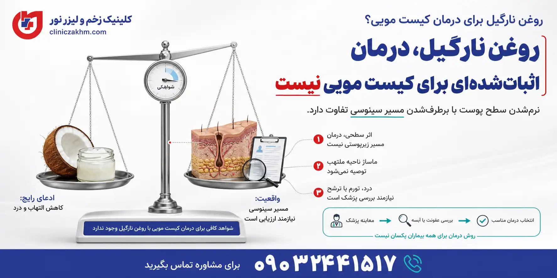درمان خانگی کیست مویی با روغن نارگیل