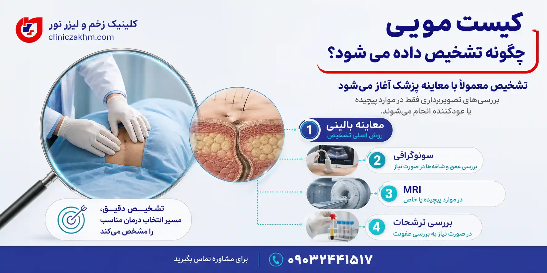 نحوه تشخیص کیست مویی