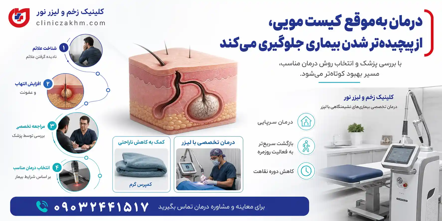 درمان زودهنگام کیست مویی برای جلوگیری از عوارض ناشی از درمان نکردن سینوس پیلونیدال