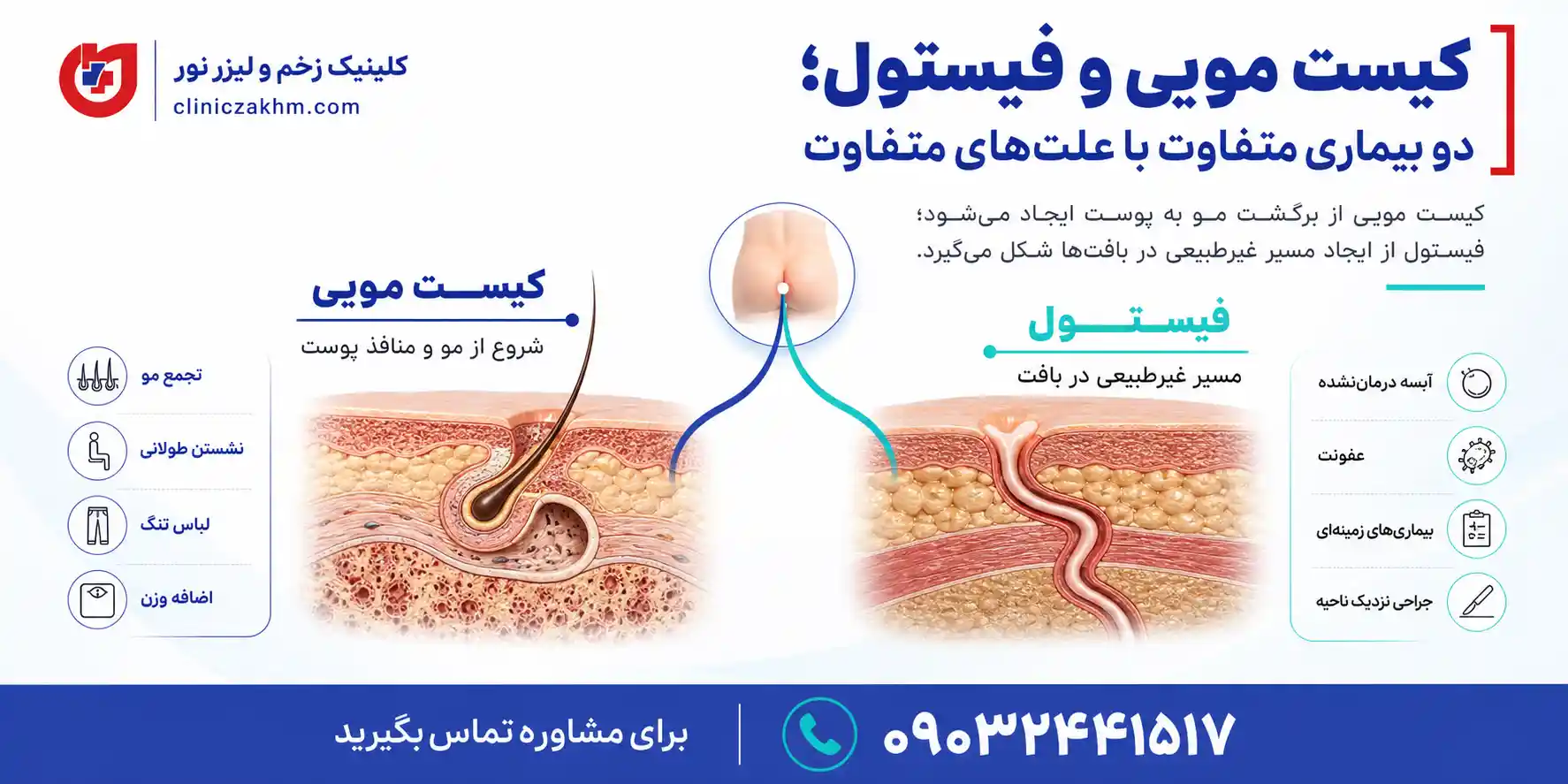 تفاوت علت بروز کیست مویی و فیستول
