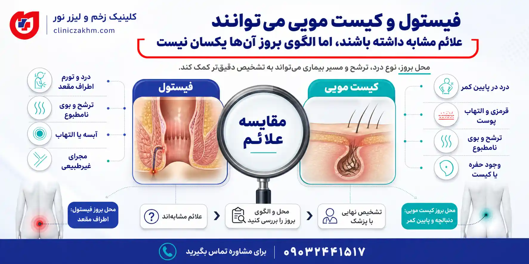 تفاوت علائم کیست مویی و فیستول و نشانه های بروز هر یک از این بیماری ها