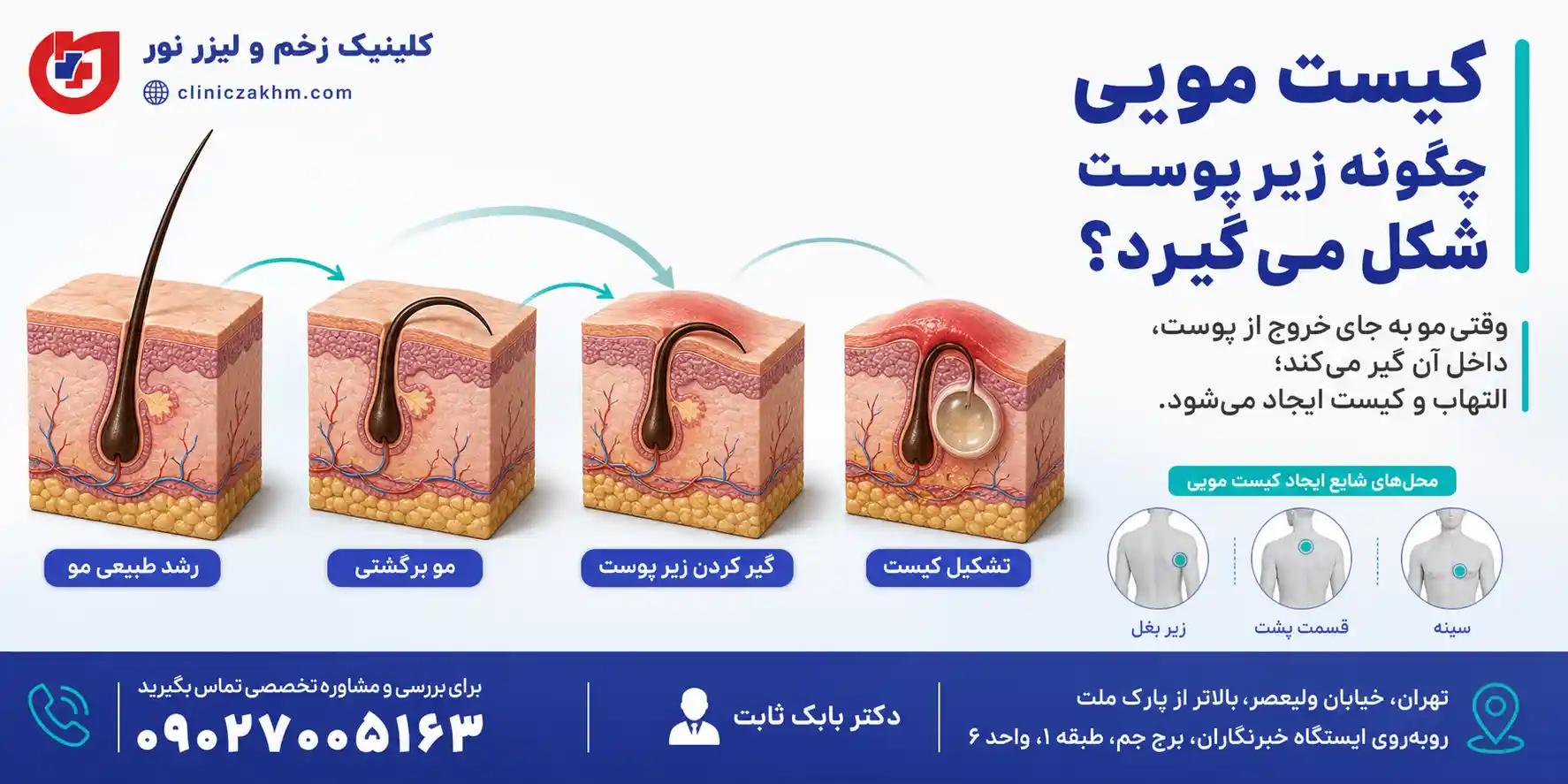 نحوه شکل گیری کیست مویی زیر پوست و فرآیند ایجاد سینوس پیلونیدال