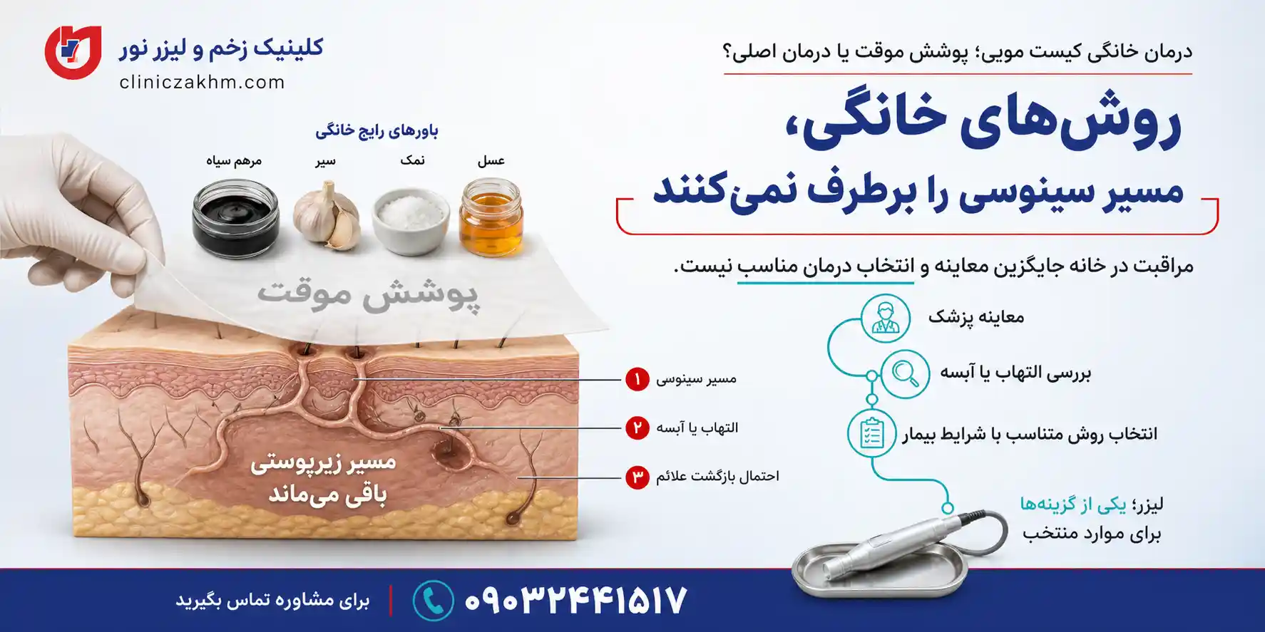 روش‌های درمان خانگی کیست مویی