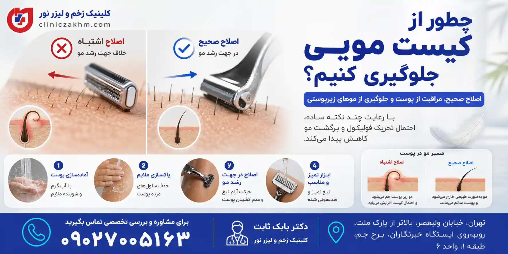 روش های پیشگیری از کیست مویی