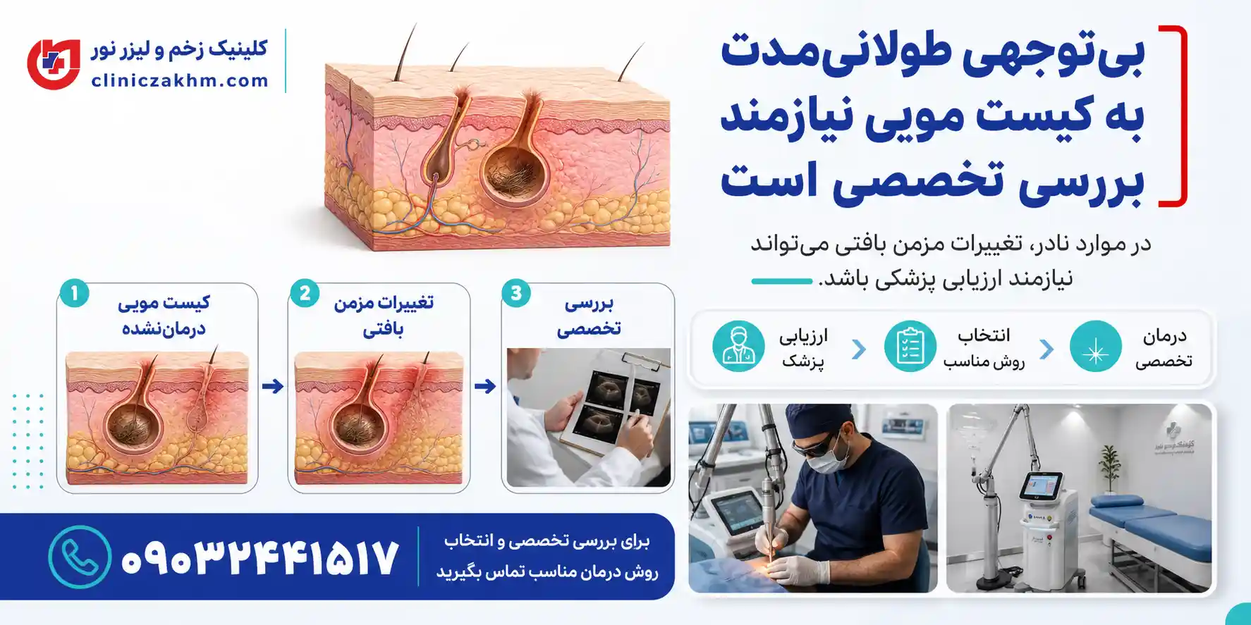 بررسی ارتباط کیست مویی درمان نشده با خطر سرطان پوست و عوارض احتمالی آن