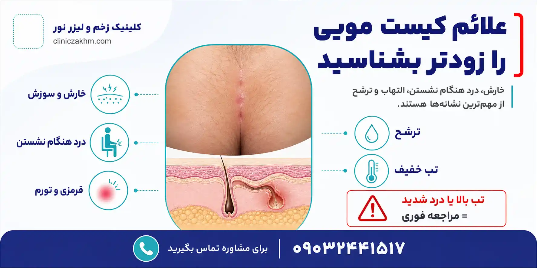 علائم کیست مویی
