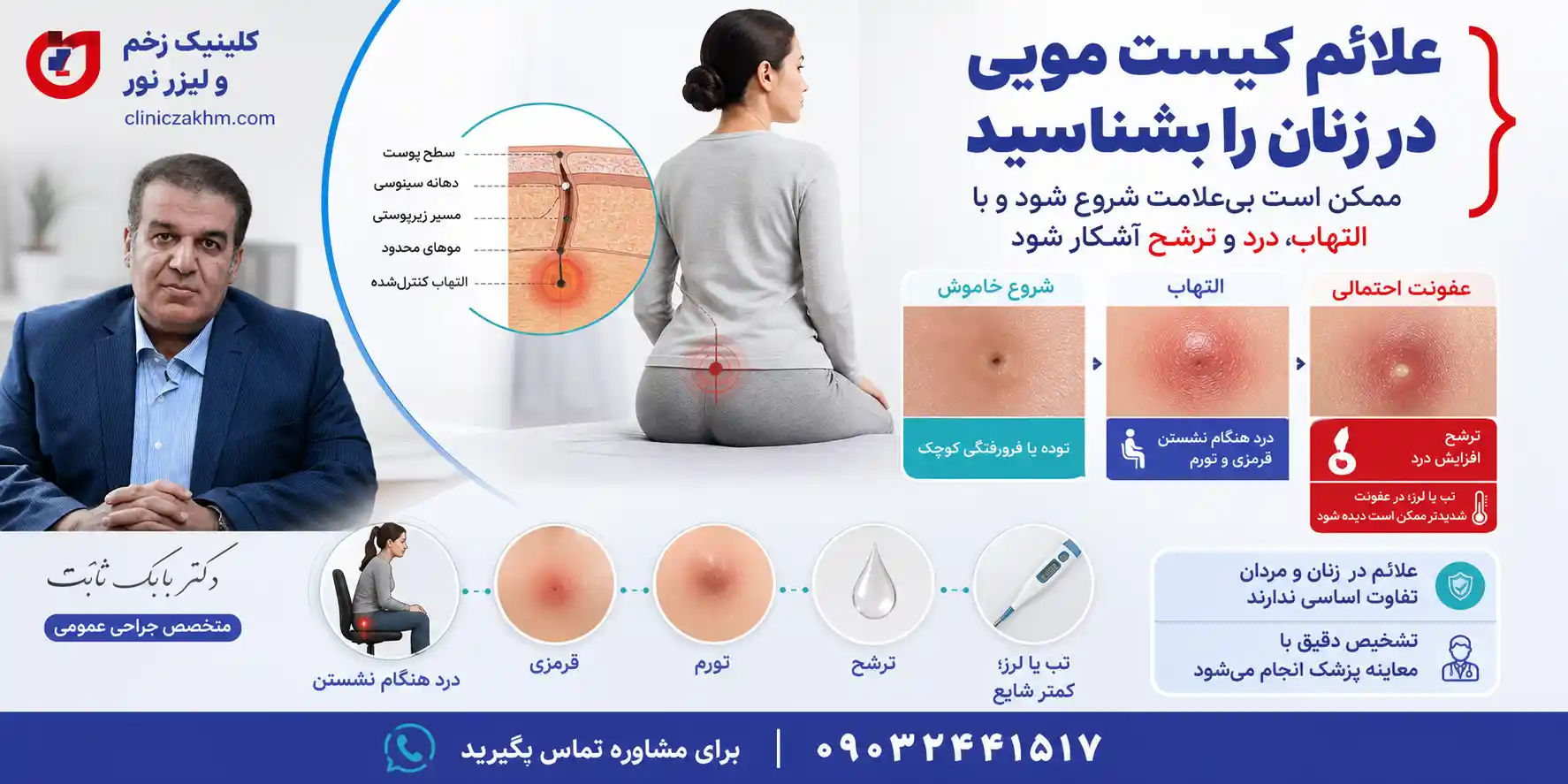 علائم کیست مویی در زنان