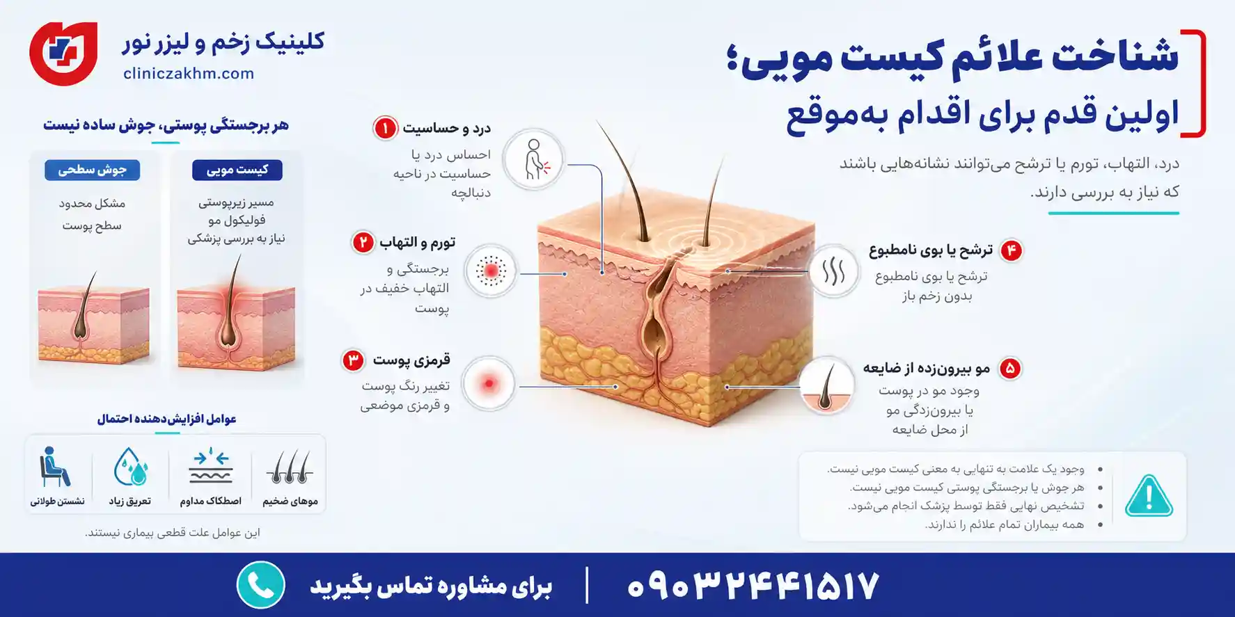 علائم کیست مویی و نشانه های اولیه بروز سینوس پیلونیدال