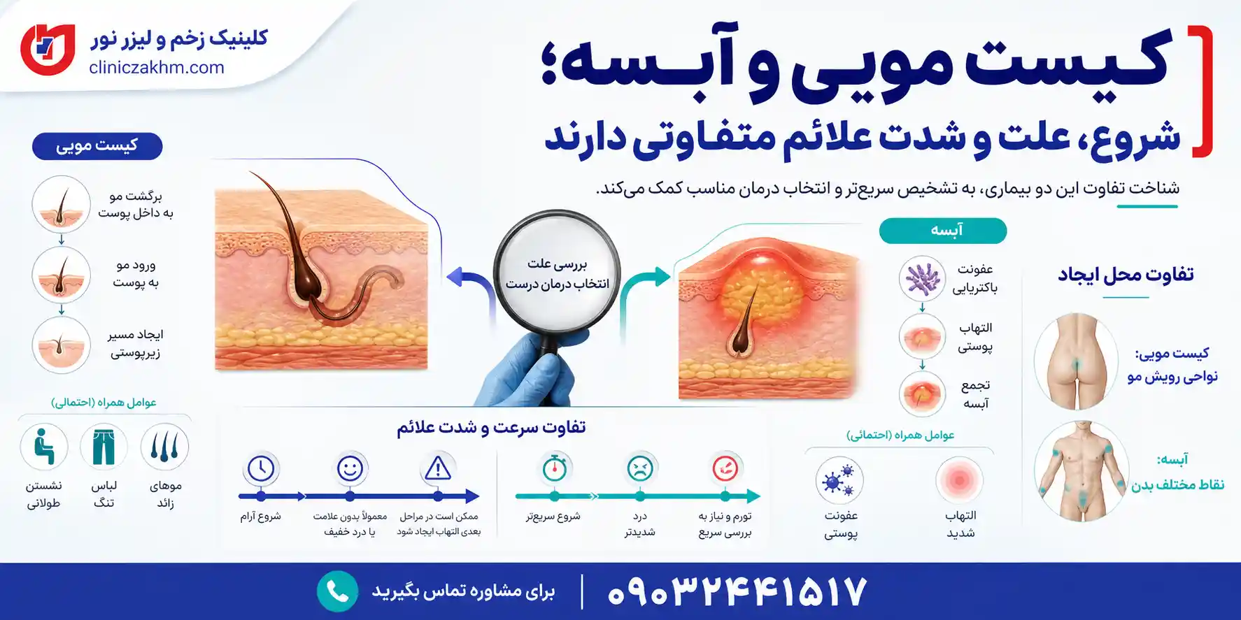 تفاوت علت بروز کیست مویی و آبسه و بررسی عوامل ایجاد کننده هر کدام