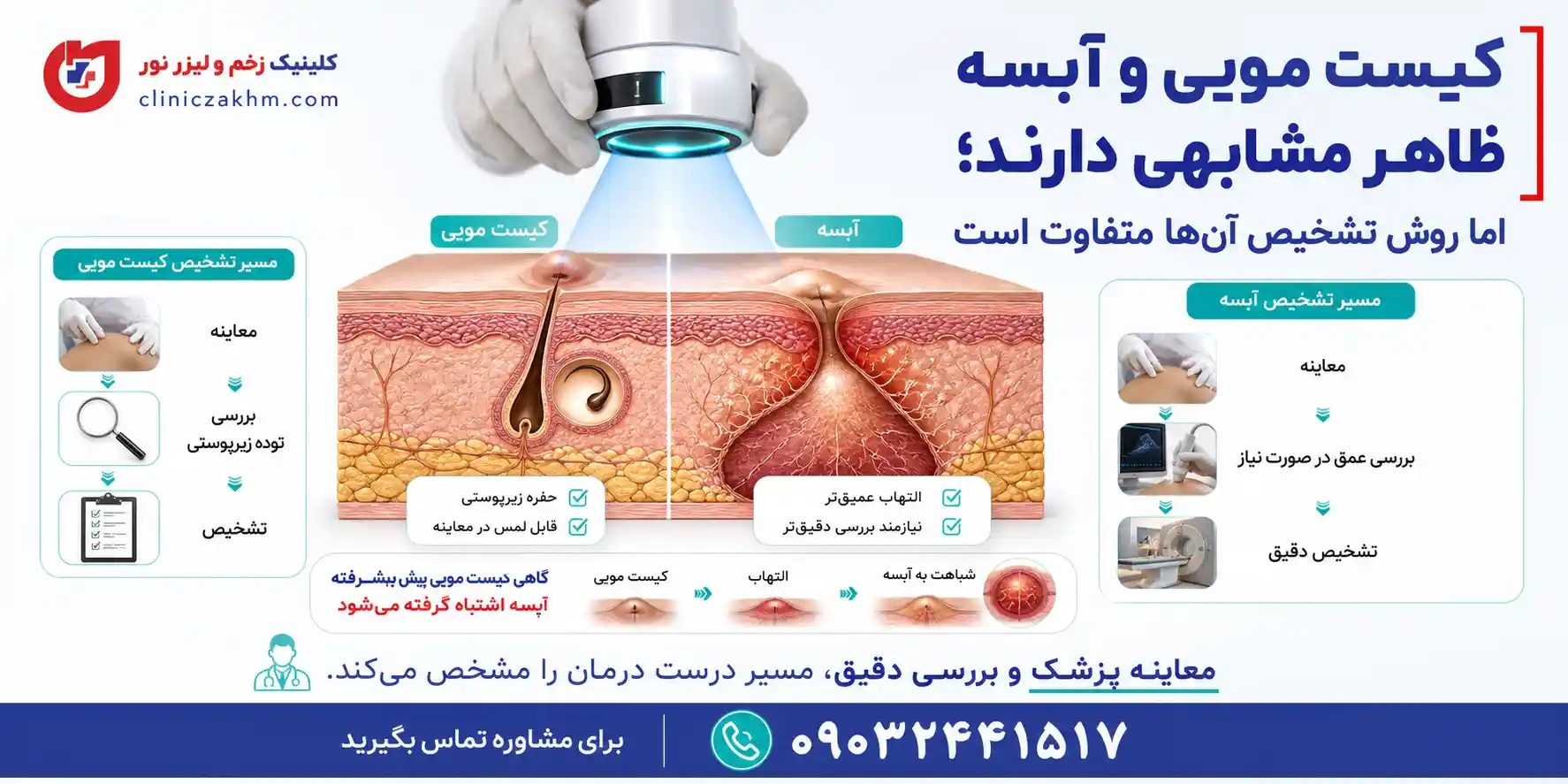 تفاوت روش تشخیص کیست مویی و آبسه و بررسی معاینه پزشکی برای شناسایی هر کدام