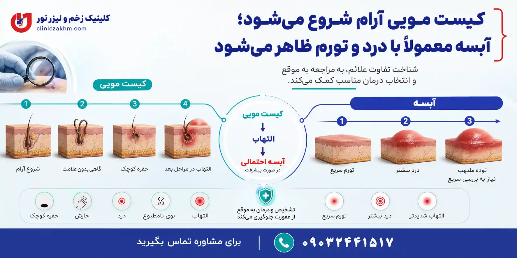 تفاوت علائم کیست مویی و آبسه و نشانه های پیدایش هر یک از این مشکلات پوستی