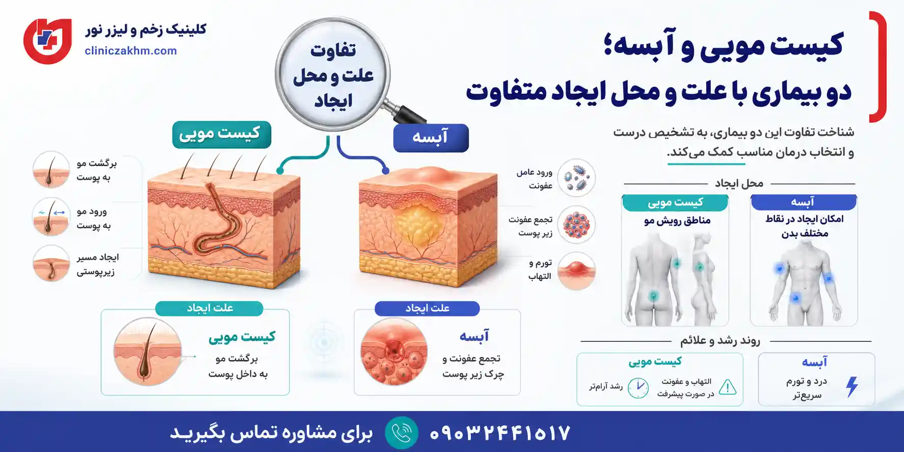 تفاوت روش درمان کیست مویی و آبسه