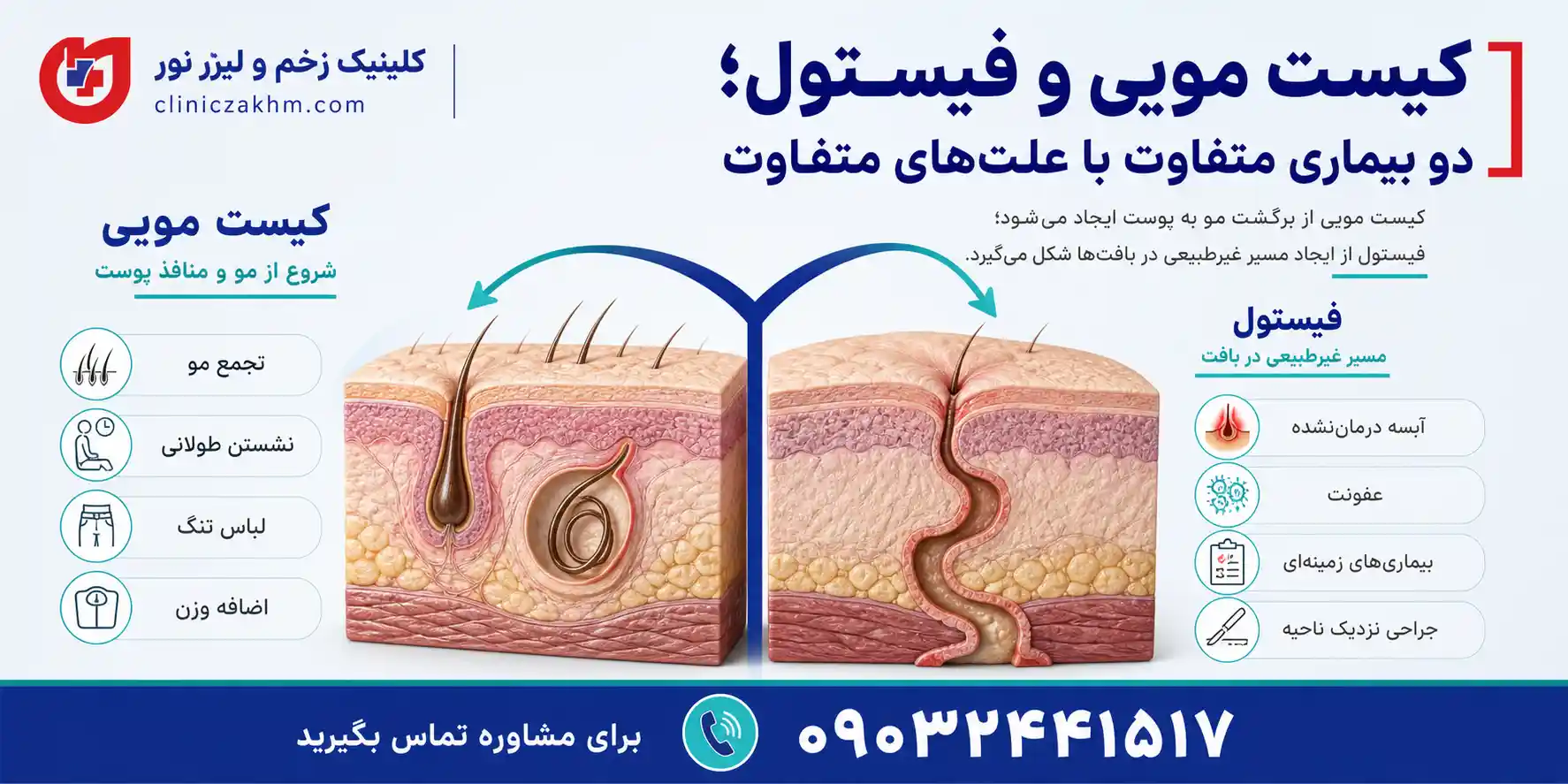 تفاوت کیست مویی و فیستول