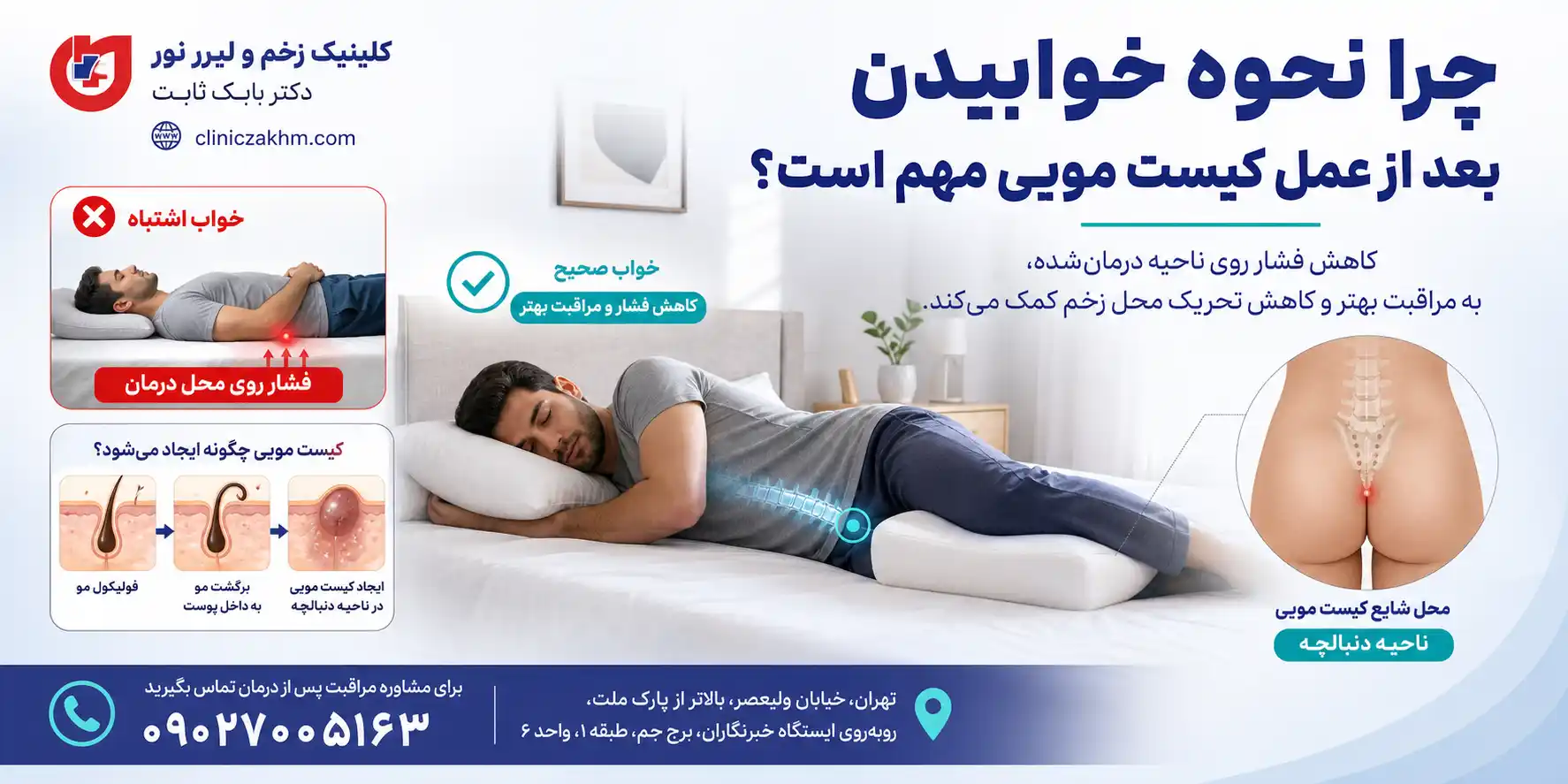 اهمیت وضعیت صحیح خوابیدن بعد از عمل کیست مویی