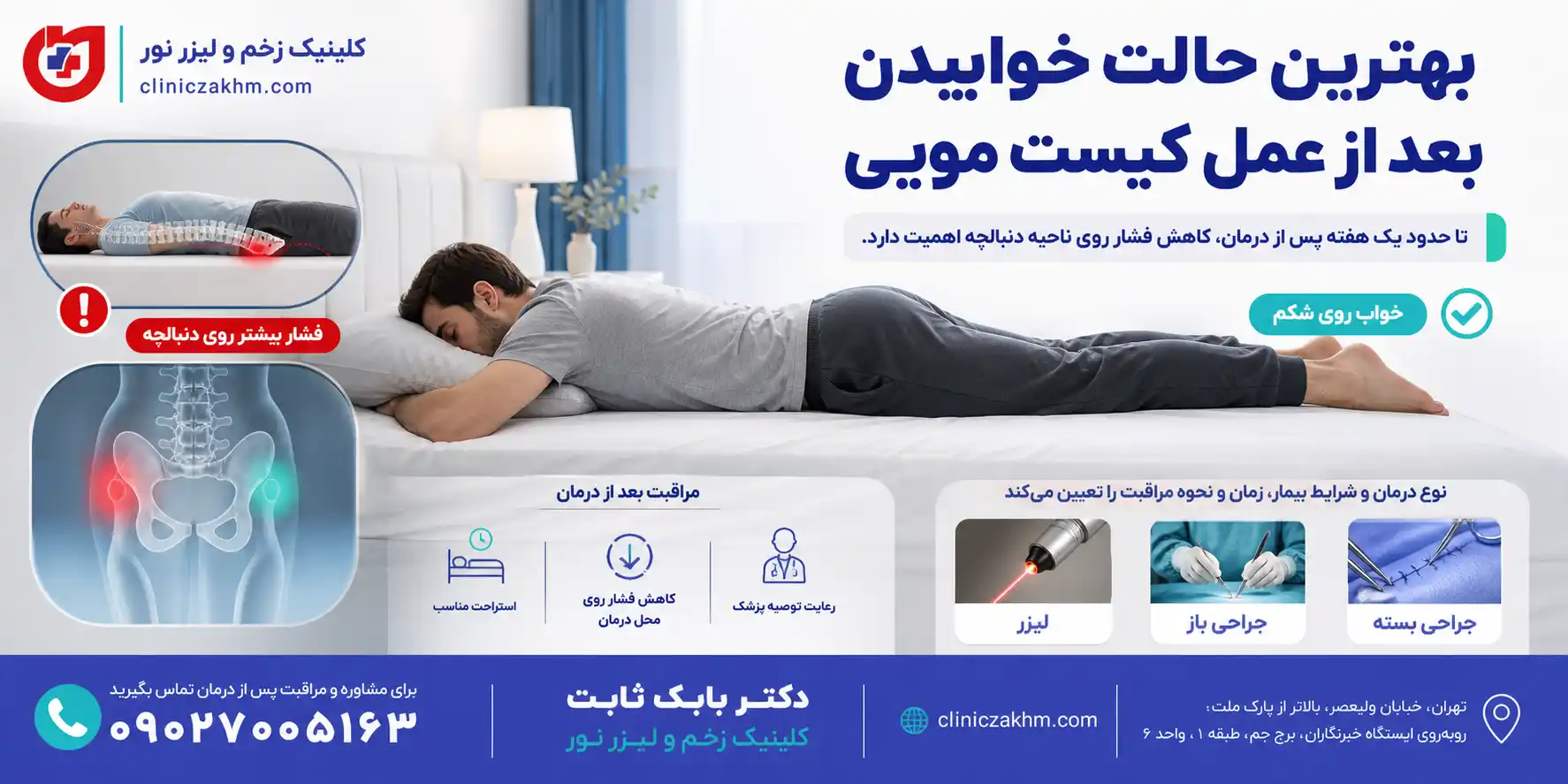 نحوه صحیح خوابیدن بعد از عمل کیست مویی برای کاهش فشار روی محل جراحی