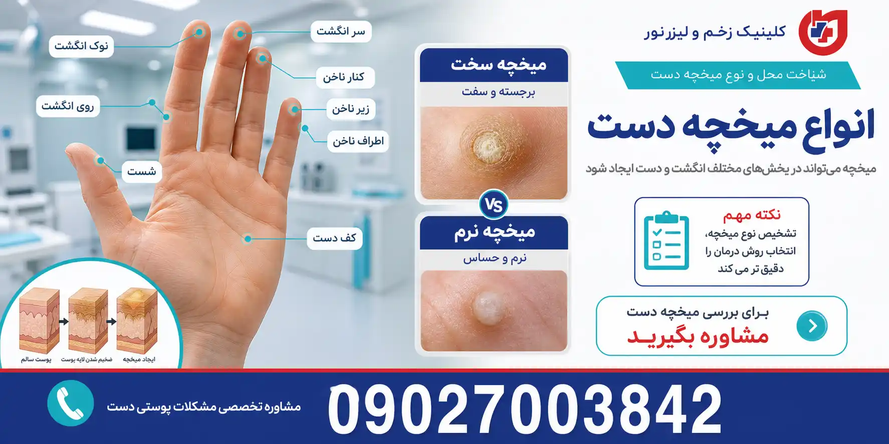 انواع میخچه دست