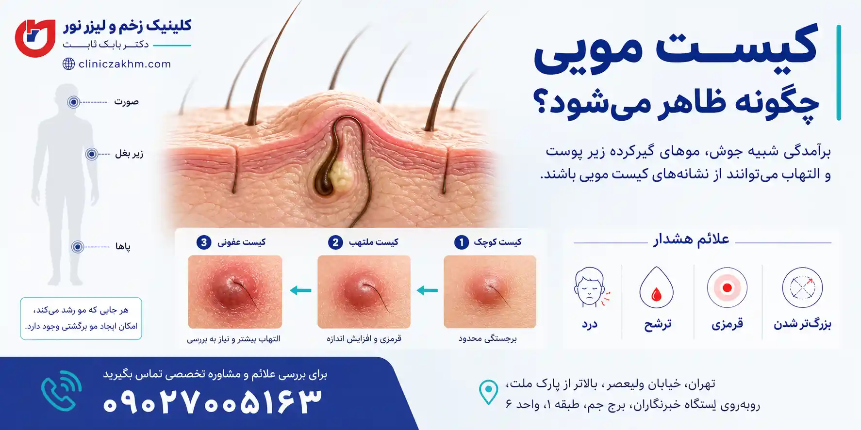 کیست مویی چگونه است