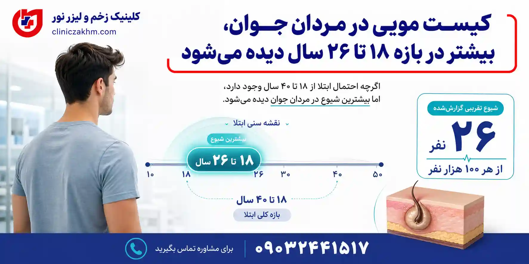 سن شایع ابتلا به کیست مویی در مردان و بررسی زمان بروز سینوس پیلونیدال