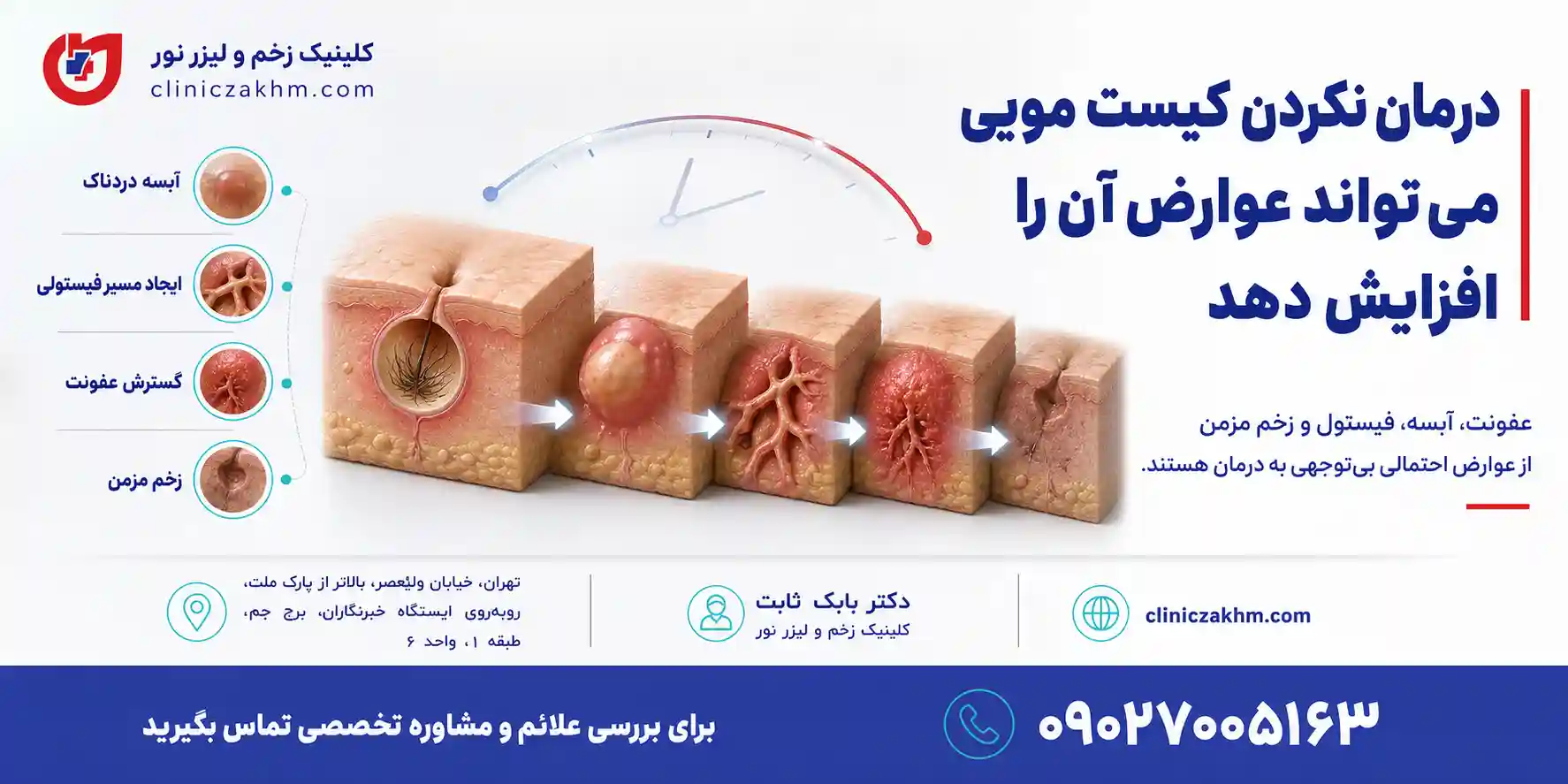 عوارض کیست مویی در مردان و پیامدهای احتمالی درمان نکردن سینوس پیلونیدال