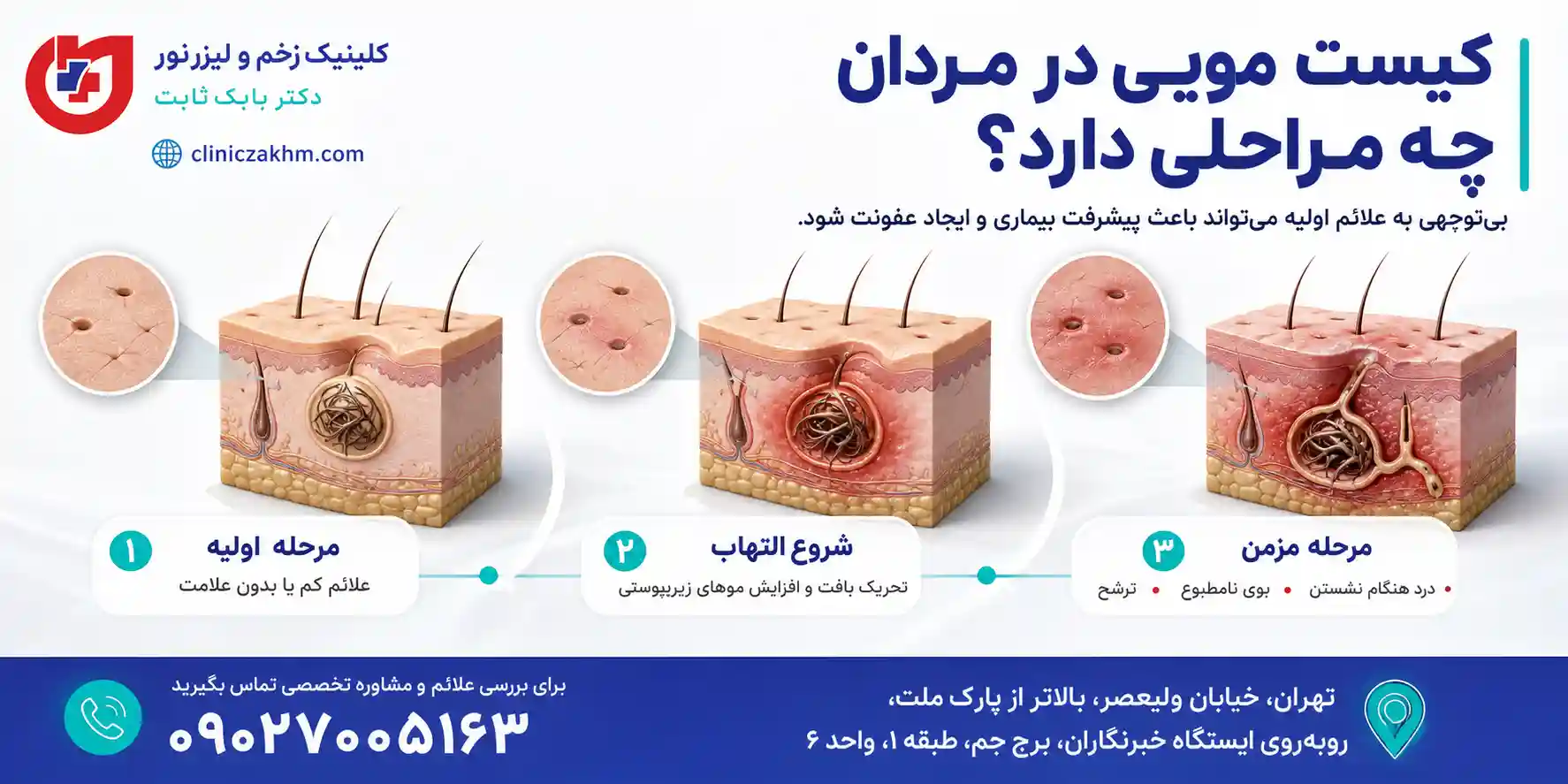 مراحل ایجاد و پیشرفت کیست مویی در آقایان و روند شکل گیری سینوس پیلونیدال