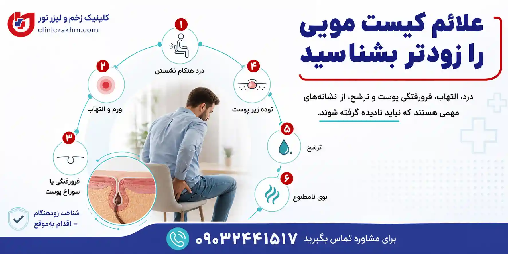 علائم کیست مویی در مردان و نشانه های بروز سینوس پیلونیدال