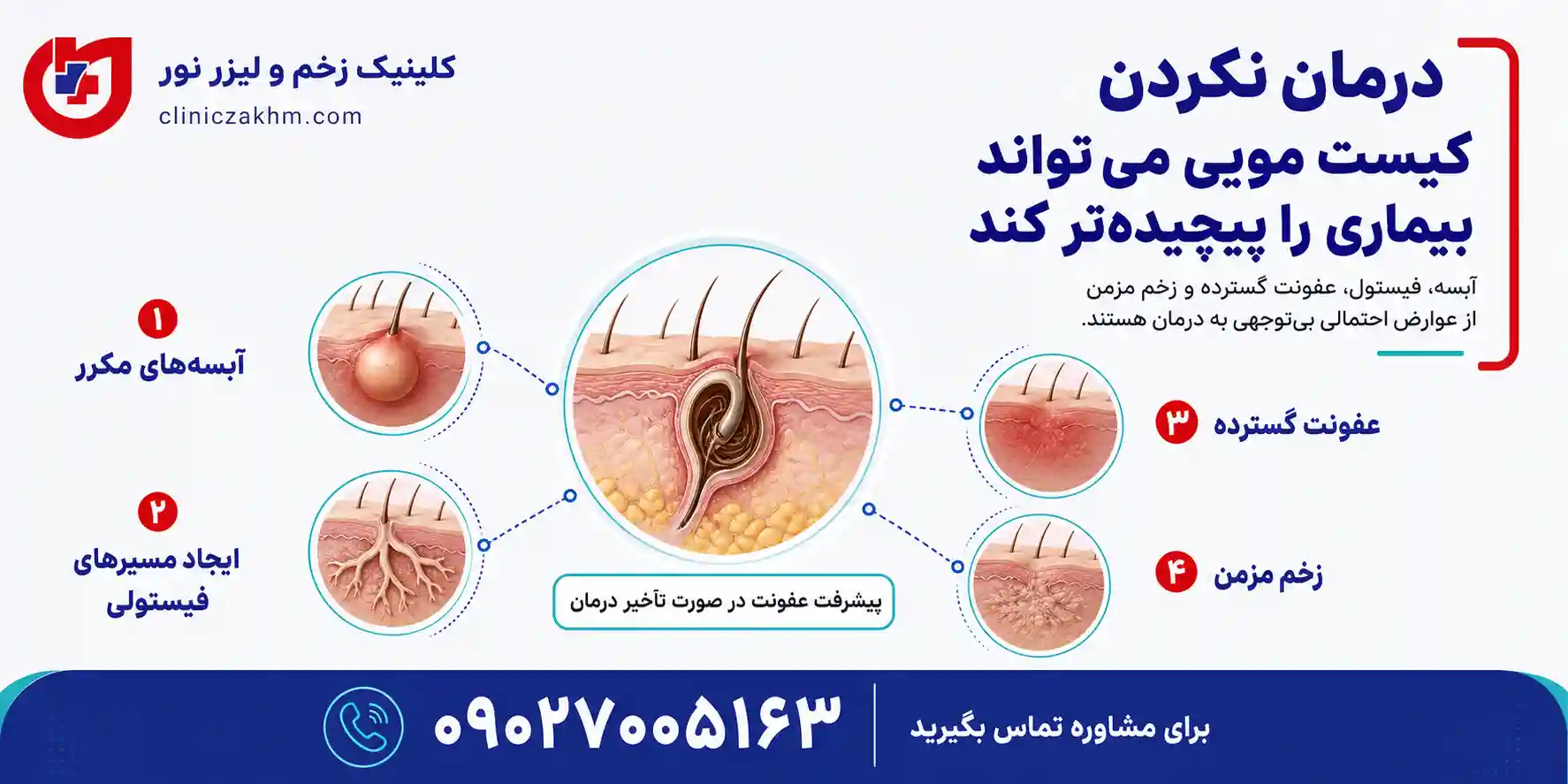 مهم ترین عوارض کیست مویی درمان نشده