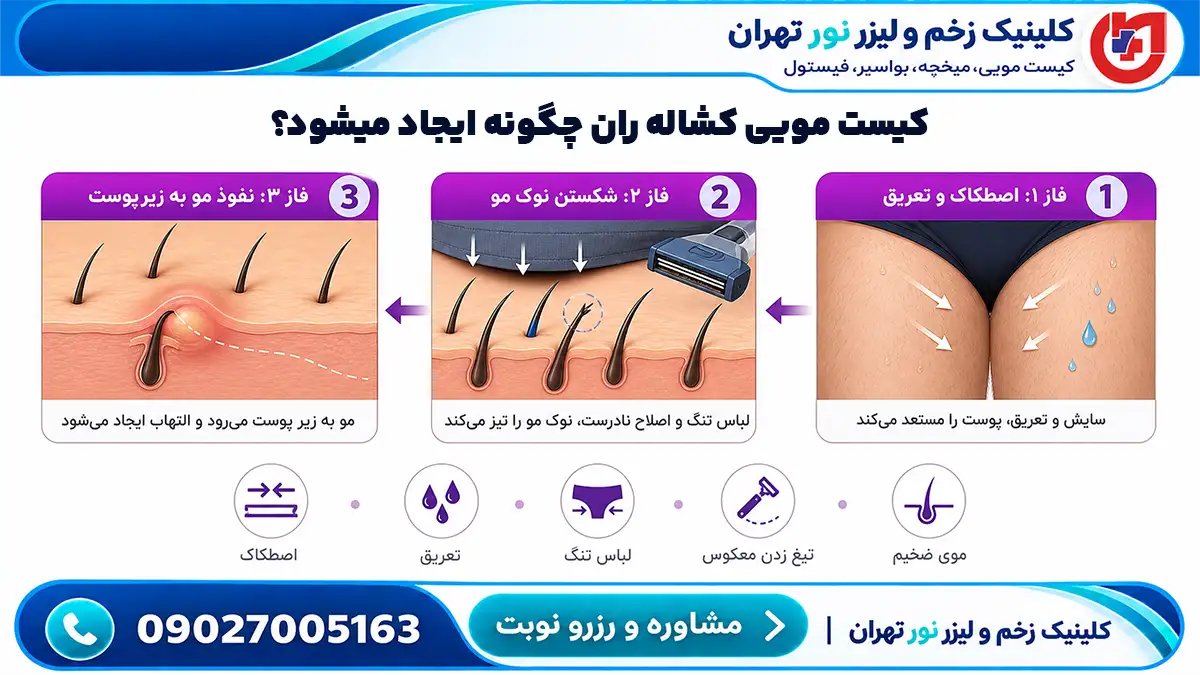 دیاگرام مراحل نفوذ مو به زیر پوست کشاله ران بر اثر اصطکاک و تعریق زیاد
