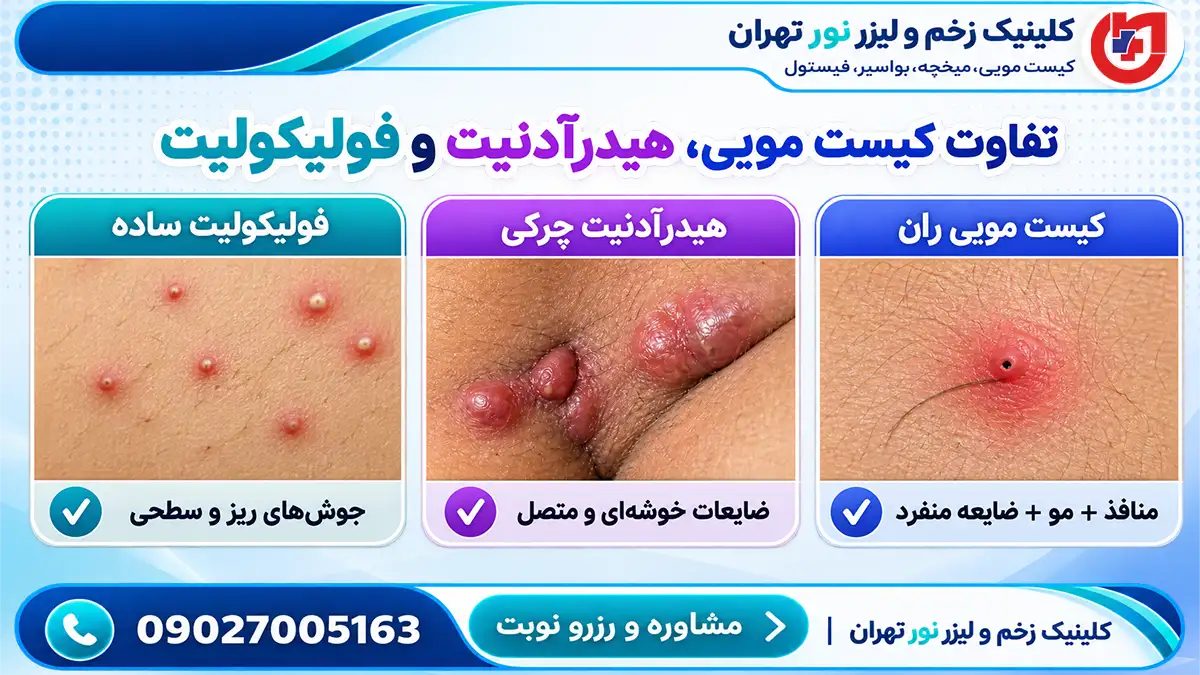 اینفوگرافیک مقایسه ظاهری کیست مویی کشاله ران با هیدرآدنیت چرکی و جوش فولیکولیت
