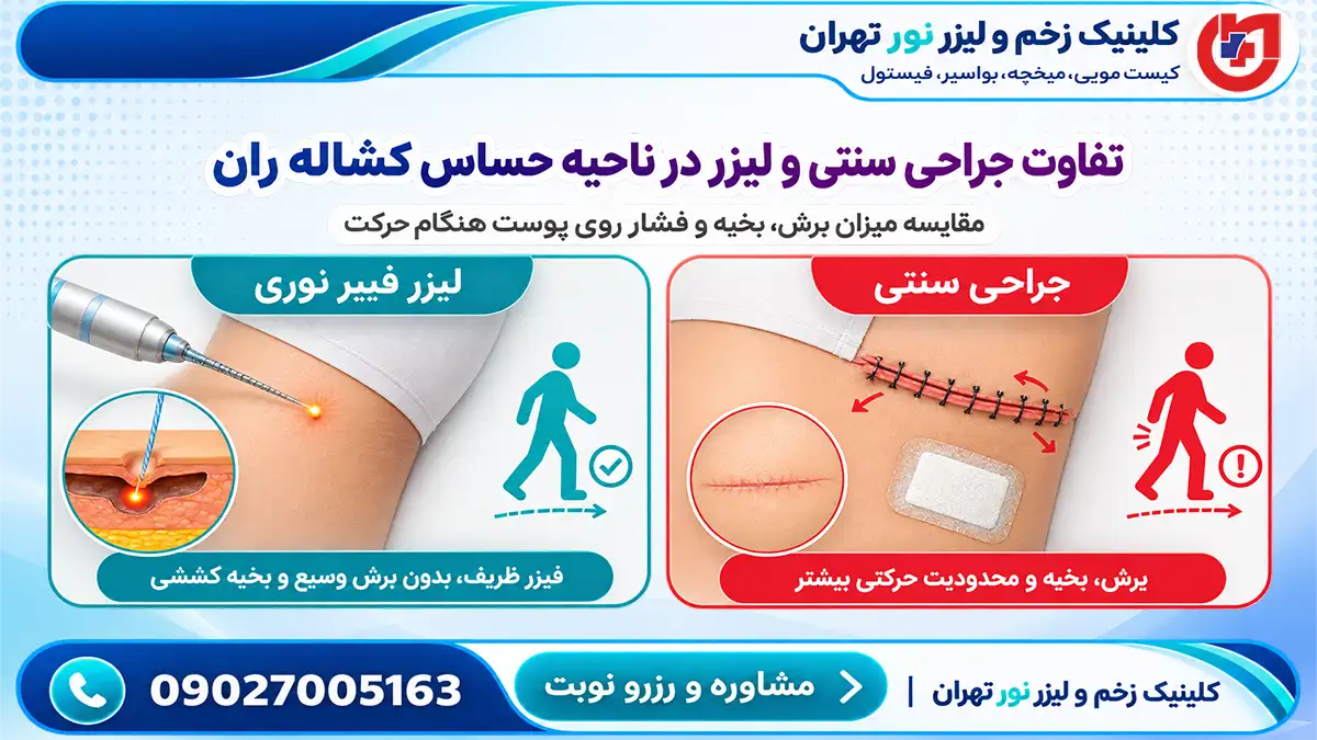 مقایسه برش جراحی سنتی با ظرافت لیزر سرپایی کیست مویی کشاله ران در کلینیک زخم نور
