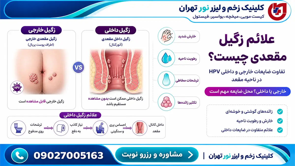 علائم اختصاصی زگیل مقعدی داخلی و خارجی
