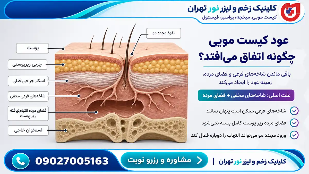 مقطع آناتومیک جا ماندن کپسول و شاخه‌های فرعی علت اصلی عود کیست مویی - کلینیک نور