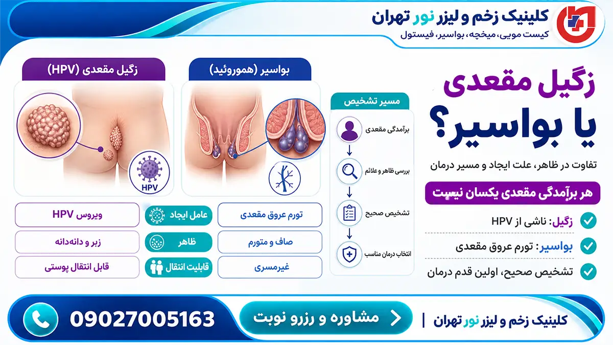 تفاوت زگیل مقعدی و بواسیر (هموروئید)