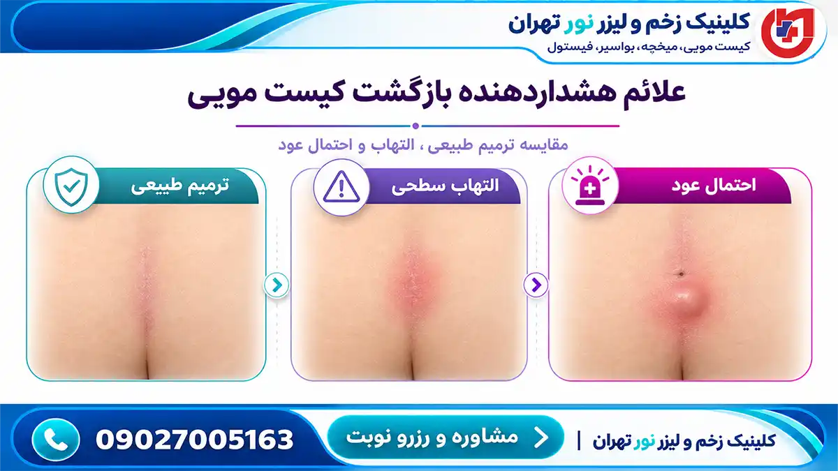 علت عود کیست مویی بعد از عمل